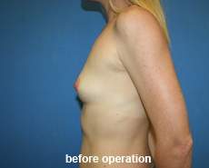 plastic-surgery-breast-augmentation